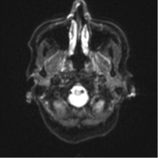 Cerebral metastasis (Radiopaedia 46744-51248 Axial DWI 2).png