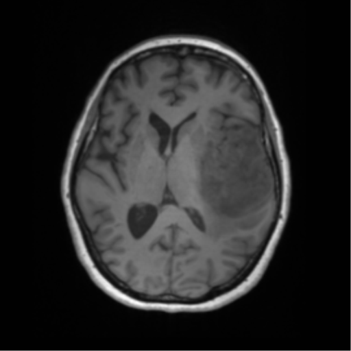 Cerebral metastasis mimicking glioblastoma (Radiopaedia 69155-78937 Axial T1 34).png