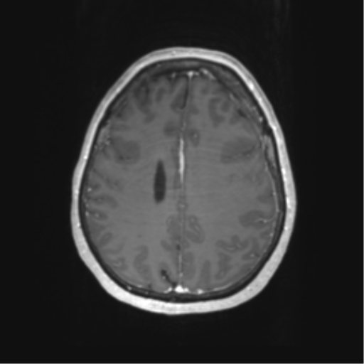 Cerebral metastasis mimicking glioblastoma (Radiopaedia 69155-78937 Axial T1 C+ 48).png