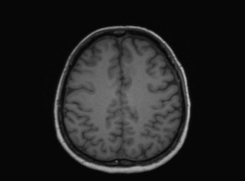 Cerebral ring enhancing lesions - cerebral metastases (Radiopaedia 44922-48817 Axial T1 171).jpg