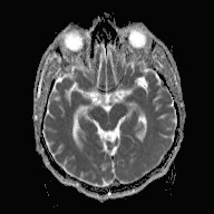 File:Cerebral toxoplasmosis (Radiopaedia 43956-47461 Axial ADC 8).jpg