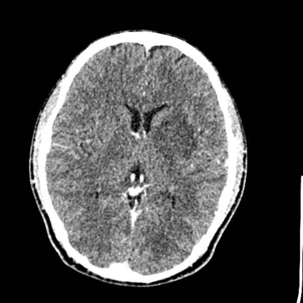 Cerebral toxoplasmosis (Radiopaedia 53993-60131 Axial C+ delayed 38).jpg