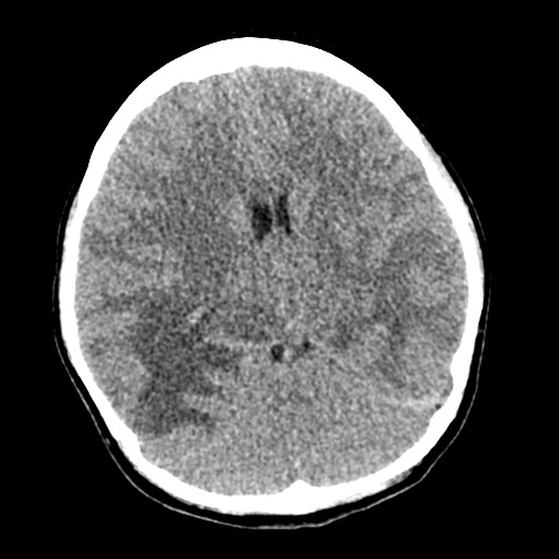 Cerebral tuberculosis with dural sinus invasion (Radiopaedia 60353-68018 Axial non-contrast 28).jpg