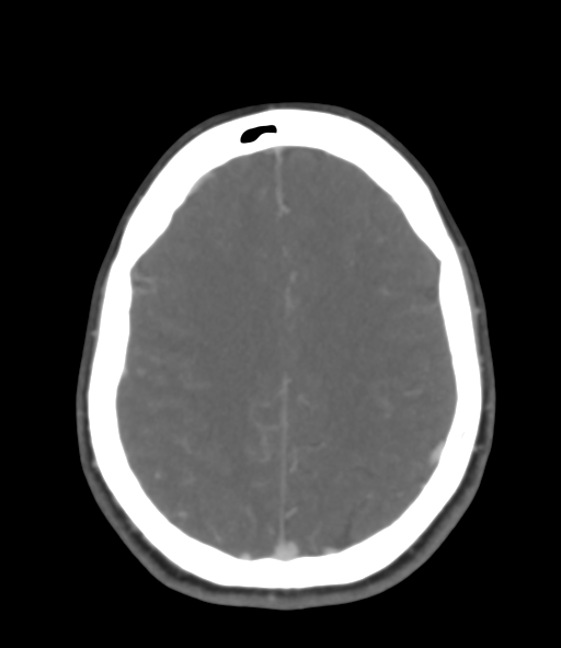 Cerebral venous hemorrhagic infarction (Radiopaedia 38461-40550 Axial MIP VENOGRAM 38).png