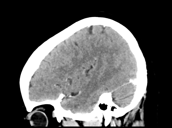 Cerebral venous hemorrhagic infarction (Radiopaedia 57576-64538 Sagittal C+ 40).png