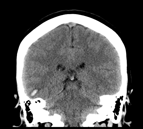 File:Cerebral venous infarct related to dural venous sinus thromboses (Radiopaedia 35292-36804 Coronal non-contrast 23).png