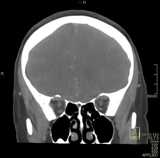 Cerebral venous sinus thrombosis (Radiopaedia 91329-108965 Coronal venogram 27).jpg