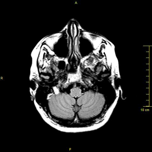 File:Cerebral venous thrombosis (Radiopaedia 23288-23351 Axial FLAIR 1).JPG