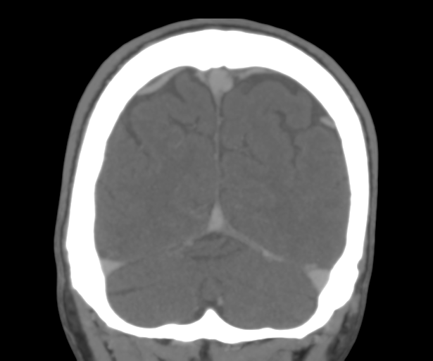 Cerebral venous thrombosis (Radiopaedia 38392-40467 Coronal CTA-Venogram 52).png