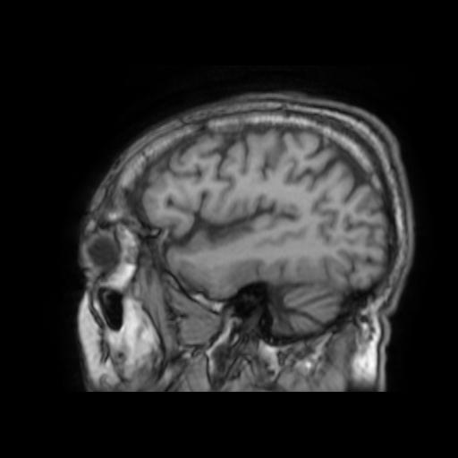 File:Cerebral venous thrombosis with secondary intracranial hypertension (Radiopaedia 89842-106957 Sagittal T1 24).jpg
