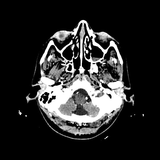Cerebral venous thrombosis with venous hemorrhagic infarct (Radiopaedia 90354-107660 Axial with contrast 23).jpg