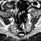 File:Cervical adenocarcinoma (Radiopaedia 65011-73985 Axial ADC 26).jpg