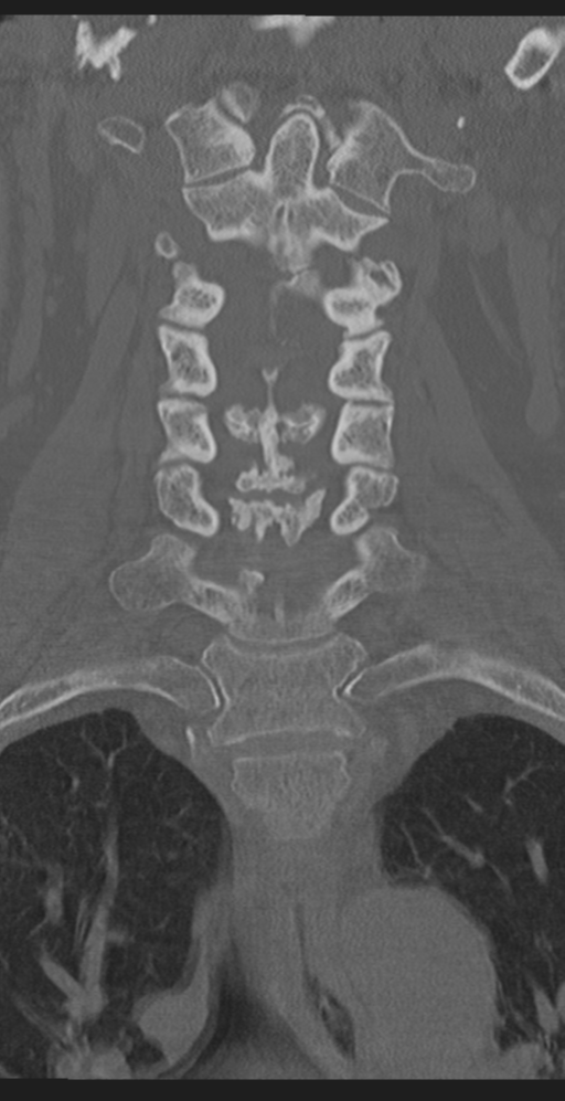 Cervical canal stenosis due to ossification of the posterior longitudinal ligament (Radiopaedia 47260-51823 Coronal bone window 24).png