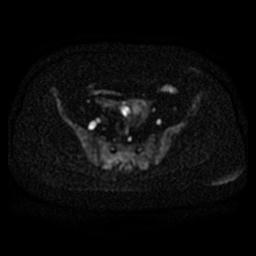 File:Cervical carcinoma (Radiopaedia 67644-77047 Axial DWI 8).jpg