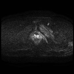 File:Cervical carcinoma (Radiopaedia 70924-81132 Axial DWI 55).jpg
