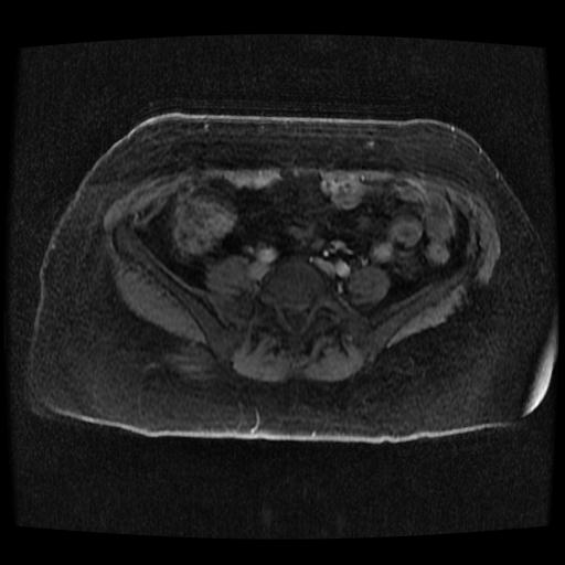 Cervical carcinoma (Radiopaedia 70924-81132 Axial T1 C+ fat sat 82).jpg