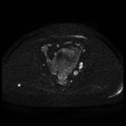 Cervical carcinoma (Radiopaedia 85405-101028 Axial DWI 72).jpg
