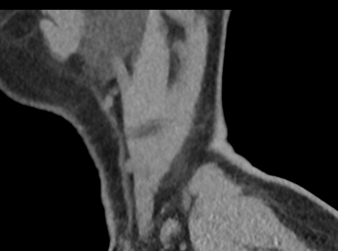 File:Cervical disc replacement (Radiopaedia 44025-47541 B 91).png