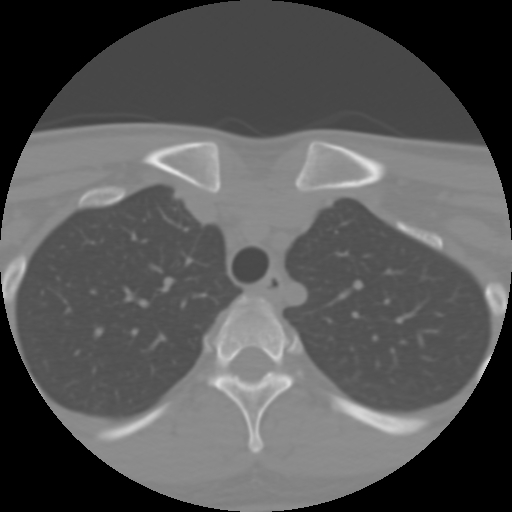 Cervical rib (Radiopaedia 71110-81363 Axial non-contrast 60).jpg
