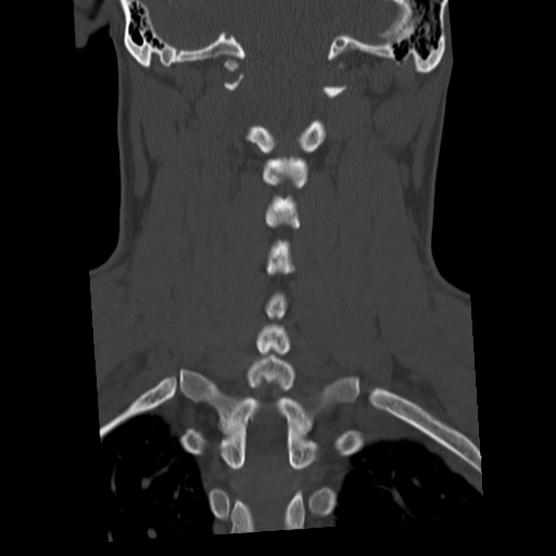 Cervical schwannoma (Radiopaedia 57979-64974 Coronal bone window 38).png