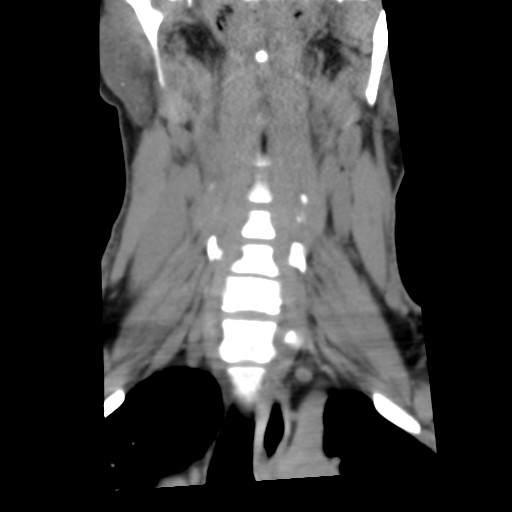 File:Cervical schwannoma (Radiopaedia 57979-64974 Coronal non-contrast 15).png
