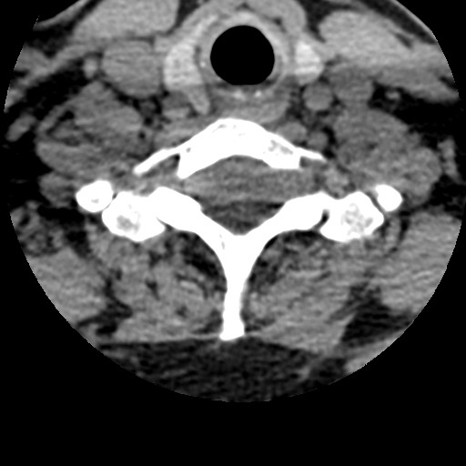 File:Cervical spinal neurofibroma in a patient with NF1 (Radiopaedia 58344-65464 Axial non-contrast 61).jpg