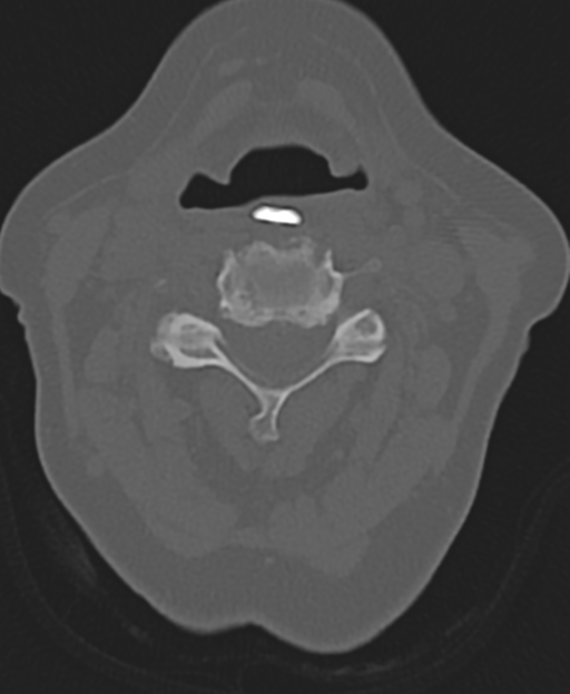 Cervical spine ACDF loosening (Radiopaedia 48998-54071 Axial bone window 27).png
