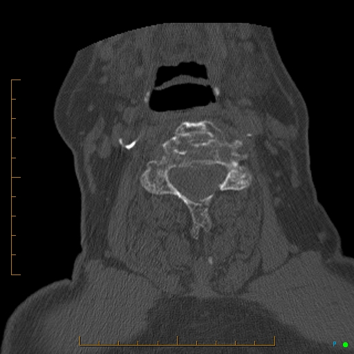 Cervical spine fracture - ankylosing spondylitis (Radiopaedia 76835-88706 Axial bone window 106).jpg