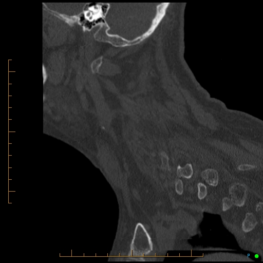Cervical spine fracture - ankylosing spondylitis (Radiopaedia 76835-88706 Sagittal bone window 25).jpg