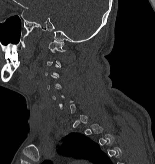 Cervical spine trauma with tear drop fracture and perched facet joint (Radiopaedia 53989-60127 Sagittal bone window 143).jpg