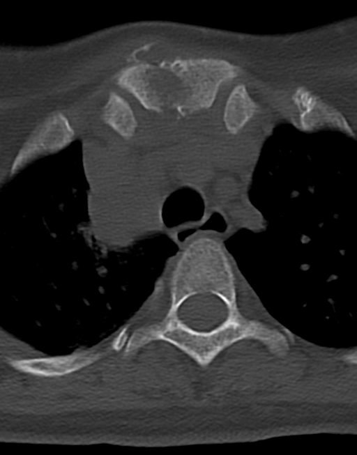 Cervical tuberculous spondylitis (Radiopaedia 39149-41365 Axial bone window 57).png