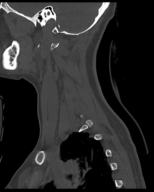 Cervical tuberculous spondylitis (Radiopaedia 39149-41365 Sagittal bone window 56).png