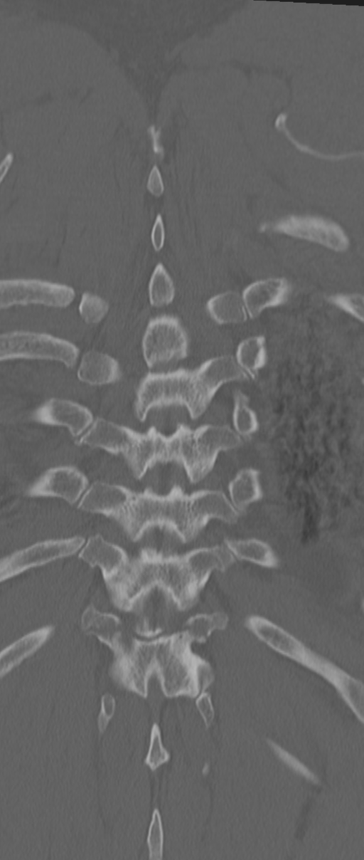 Chance fracture (Radiopaedia 33854-35020 Coronal bone window 71).png