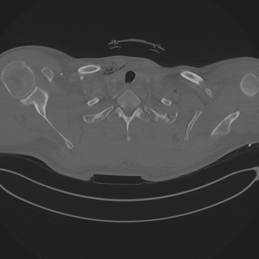 Chest multitrauma - aortic injury (Radiopaedia 34708-36147 Axial bone window 19).png