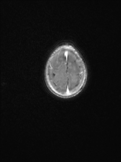 Chiari III malformation with occipital encephalocele (Radiopaedia 79446-92559 Axial T1 C+ mpr 75).jpg