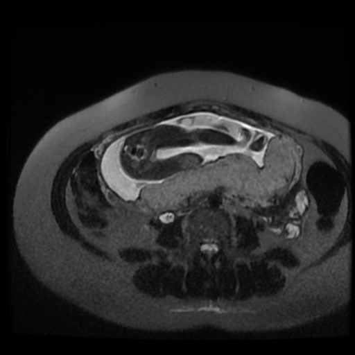 Chiari II malformation - fetal MRI (Radiopaedia 68099-77581 Axial T2-SSFSE 10).jpg
