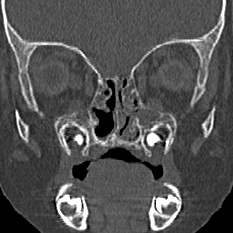 Choanal atresia (Radiopaedia 88525-105975 Coronal bone window 45).jpg
