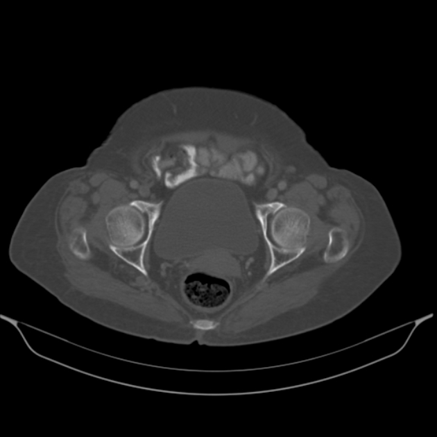 Cholangiocarcinoma (Radiopaedia 50592-56025 Axial bone window 68).jpg