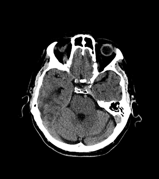 Cholangiocarcinoma with cerebral metastases (Radiopaedia 83519-98628 Axial non-contrast 25).jpg