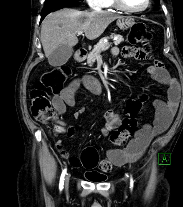Cholangiocarcinoma with cerebral metastases (Radiopaedia 83519-98629 E 36).jpg