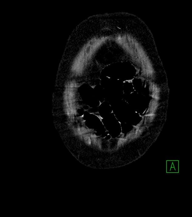 Cholangiocarcinoma with cerebral metastases (Radiopaedia 83519-98629 E 6).jpg
