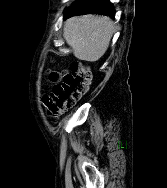 Cholangiocarcinoma with cerebral metastases (Radiopaedia 83519-98629 F 101).jpg