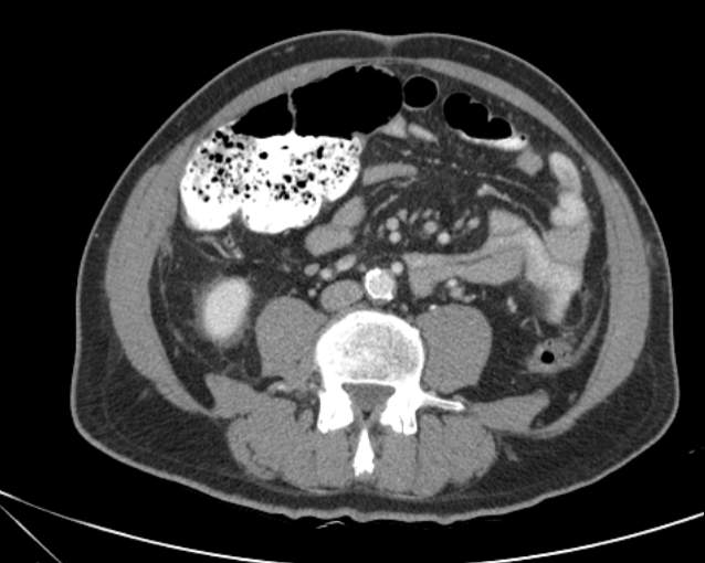 File:Cholecystitis - perforated gallbladder (Radiopaedia 57038-63916 A 49).jpg