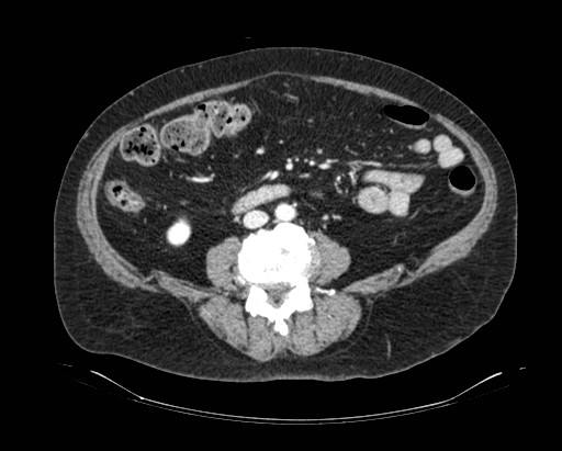 Cholecystoduodenal fistula (Radiopaedia 48959-54022 A 14).jpg
