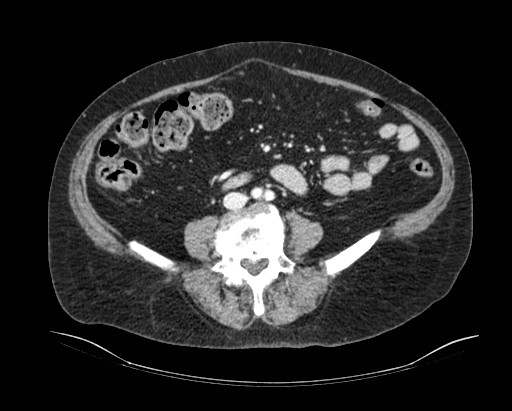Cholecystoduodenal fistula (Radiopaedia 48959-54022 A 4).jpg