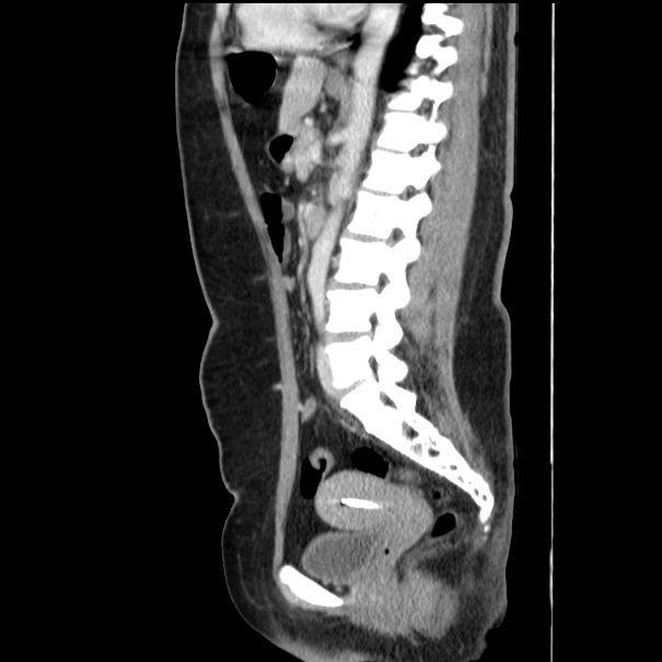 Choledocholithiasis on CT and MRI (Radiopaedia 24825-25087 D 36).jpg