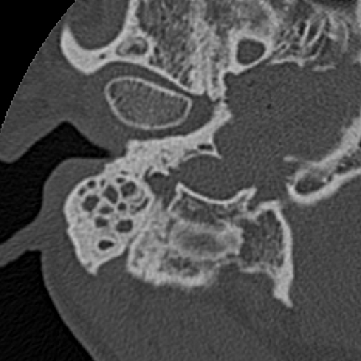 File:Cholesteatoma (Radiopaedia 15846-15494 bone window 27).jpg