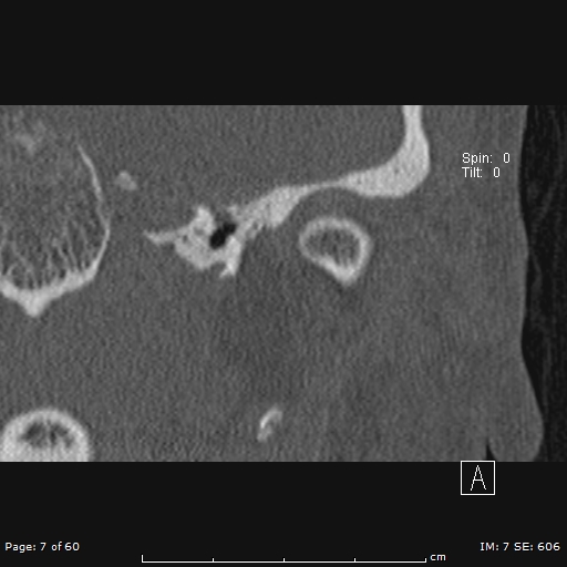 Cholesteatoma - external auditory canal (Radiopaedia 88452-105096 Coronal bone window 7).jpg