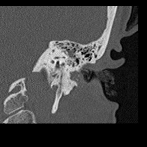 File:Cholesteatoma of the external ear (Radiopaedia 16540-16225 Coronal bone window 17).jpg