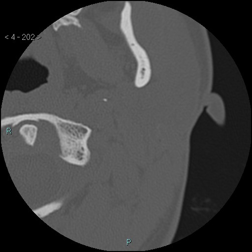 File:Cholesterol granuloma of the petrous apex (Radiopaedia 64358-73141 Axial bone window 97).jpg